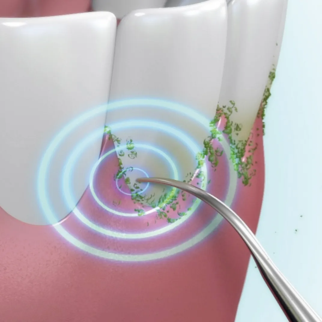 Salle De Bain Et Hygiène|Tempsl Détartreur ultrasons